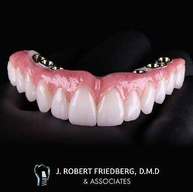 Hybrid Implant Bridge